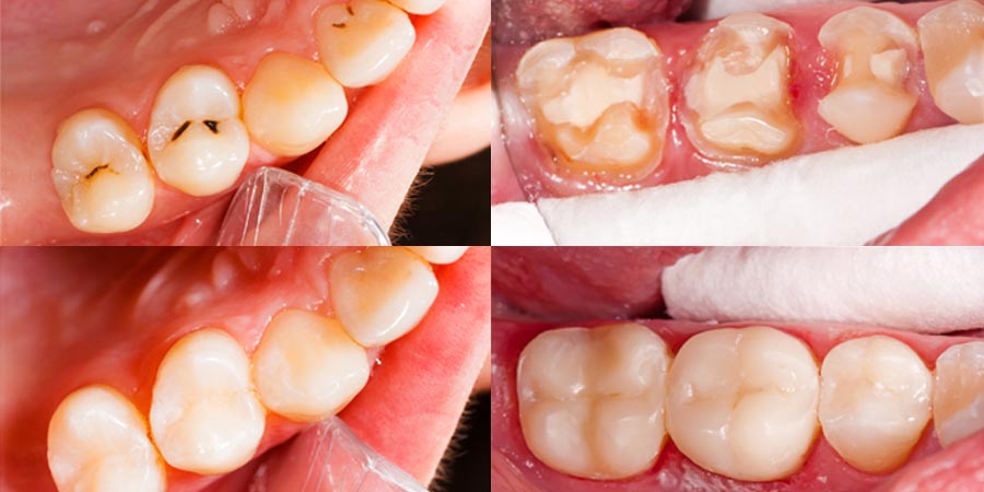Fillings and Crowns